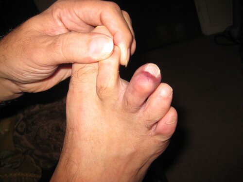 my toe1