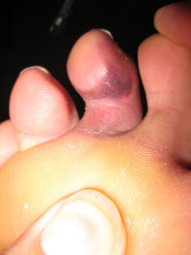 my toe2